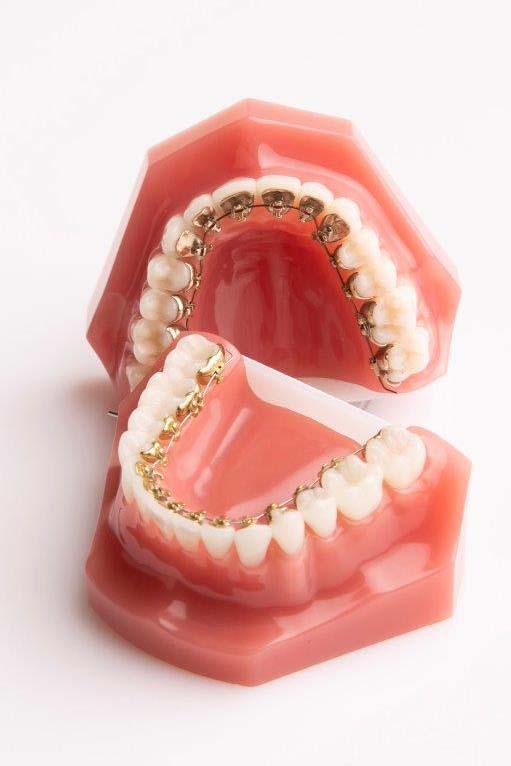 opwinding Grit Klagen Blokjes beugel of onzichtbare beugel - Orthodontie Schreurs